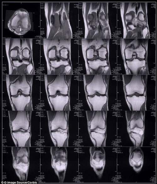 膝关节核磁共振扫描准确率高 有望取代指纹识别