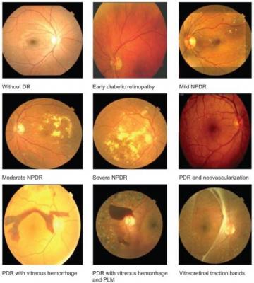 糖尿病性视网膜病变-视网膜眼底扫描